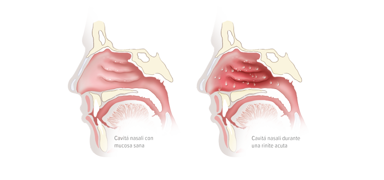 Mucosa nasale infiammata - Apoteca Natura
