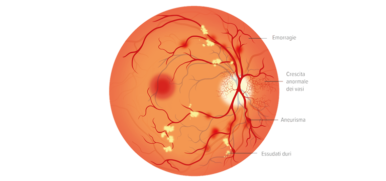 Retinopatia diabetica - Apoteca Natura