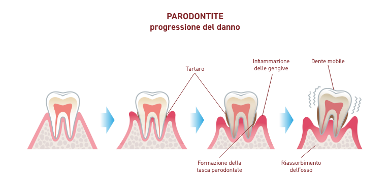 Batteri e infiammazione gengivale - Apoteca Natura