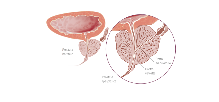 Iperplasia prostatica benigna (IPB) - Apoteca Natura