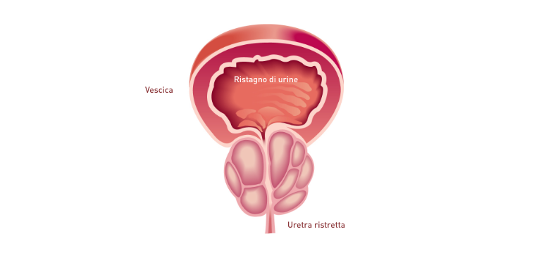 Ritenzione di urine e distensione della vescica nella iperplasia prostatica benigna (IPB) - Apoteca Natura