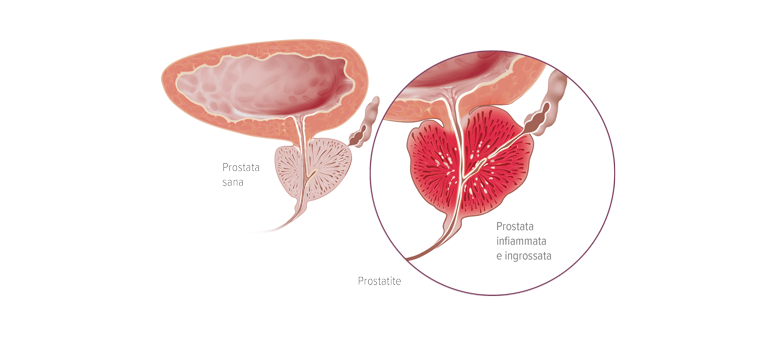 Prostatite batterica acuta - Apoteca Natura