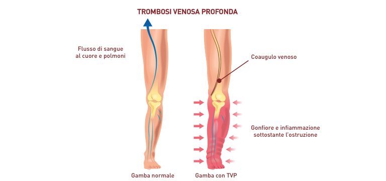 Trombosi venosa profonda - Apoteca Natura