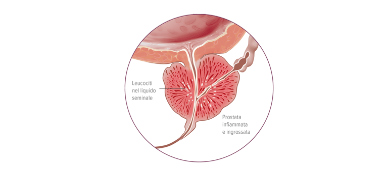 Prostatite cronica infiammatoria senza infezione batterica - Apoteca Natura