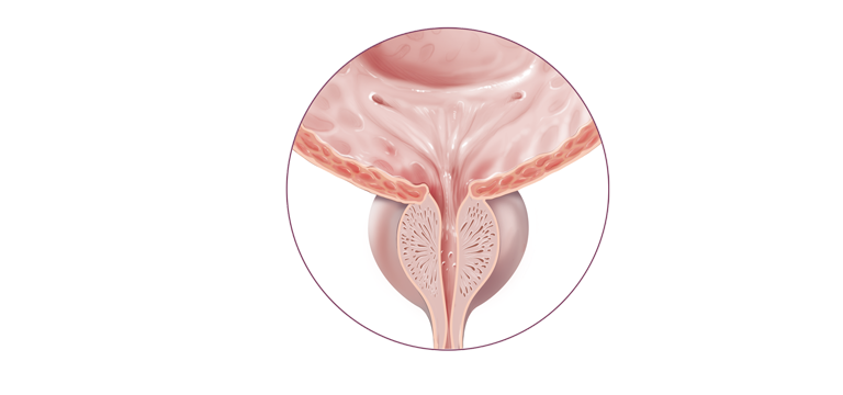 Prostatite cronica non infiammatoria senza infezione batterica - Apoteca Natura