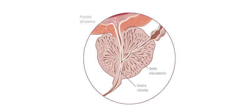 Dimensioni della prostata nel corso degli anni - Apoteca Natura