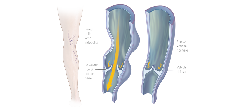 Vene varicose (varici) - Apoteca Natura