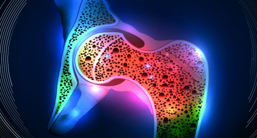 Human hip joint and Osteoporosis on a abstract blue background